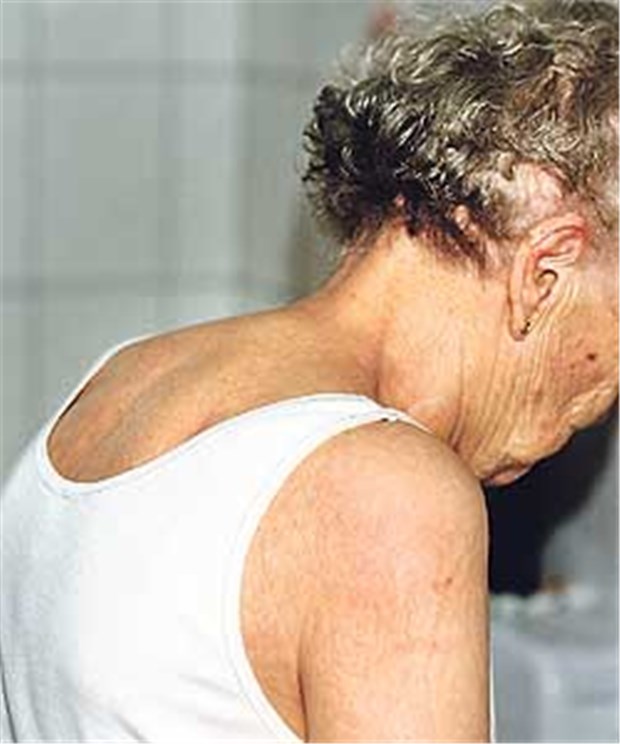 Fünf Mythen über Osteoporose Osteoporotischen Wirbelkörperfrakturen nach der Menopause lässt sich vorbeugen.