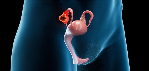 3D-Rendering eines weiblichen Unterleibs. Auf einem Eierstock ist ein Tumor zu erkennen. 