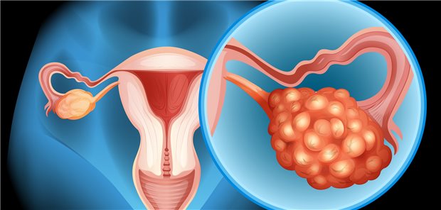 Ovarialkrebs: In der Leitlinie finden sich keine klaren Aussagen, wie man bei Frauen mit serösem tubarem intraepithelialem Karzinom genau vorgehen sollte.
