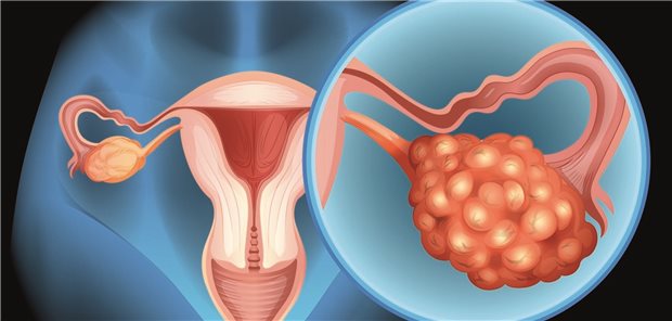 Ovarialkrebs: Nach dem Mammakarzinom ist Eierstockkrebs die zweithäufigste tödliche gynäkologische Krebserkrankung.