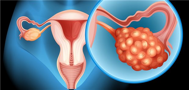Ovarialkrebs – welche Frau mit Ovarialläsionen braucht eine weitere Abklärung hinsichtlich Krebs? Ein US-Forscherteam macht einen Vorschlag, wie Doppler-Sonographiebilder helfen können, diese Frage zu beantworten.