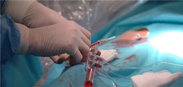 PCI: Wie viele Gefäße müssen revaskularisiert werden?