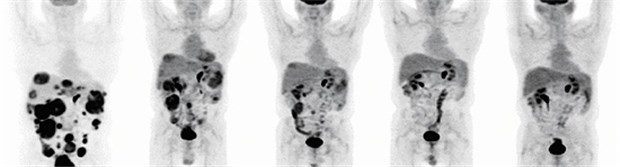 PET-Aufnahme bei einem GIST-Patienten.