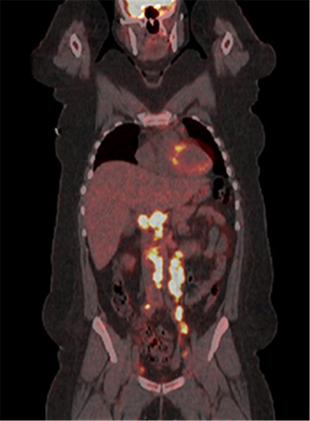 GBA-Kompromiss zur PET löst geteiltes Echo aus PET/CT eines Lymphom-Patienten vor dem Start der Therapie.