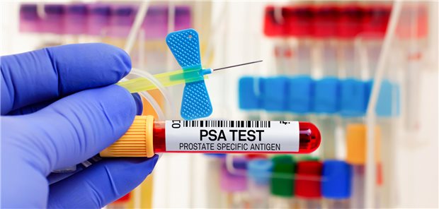 PSA-Screening: Darüber, welches der beste Zeitpunkt für den Start des Prostatakrebs-Screenings ist, gehen die Meinungen internationaler Fachgesellschaften auseinander.