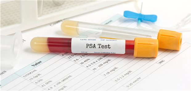 PSA-Screening: Sinnvoll oder nicht? Die Meinungen gehen auseinander.