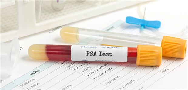 PSA-Test: Viele Experten plädieren dafür, ihn zur Prostatakarzinom-Diagnostik risiko-adaptiert einzusetzen.