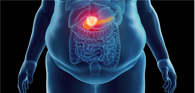 Pankreas-Karzinom: Nur ein Beispiel für eine Krebserkrankung, die bei Diabetes mellitus und Adipositas gehäuft auftritt.