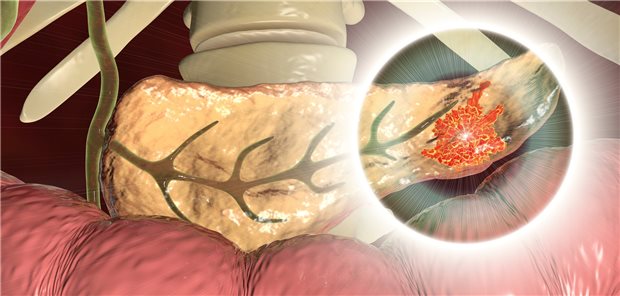 Pankreas-Karzinom im Fokus: Mit einer neuartigen Zelltherapie ist des gelungen, einen metastasierten Tumor erheblich zu verkleinern.