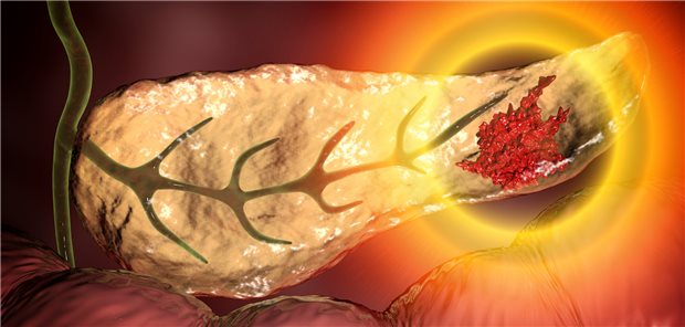 Pankreas mit Karzinom: Bei grenzwertig resektablem duktalem Tumor wird in den Leitlinien eine präoperativen Chemo(radio)therapie empfohlen.

