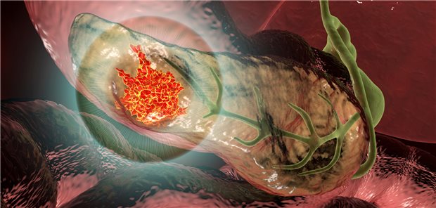 Pankreaskarzinom: Bei 85 Prozent der Patientinnen und Patienten mit inoperablem Pankreaskarzinom lassen sich durch Behandlung mit hochintensivem fokussiertem Ultraschall tumorbedingte Schmerzen lindern. (Symbolbild)