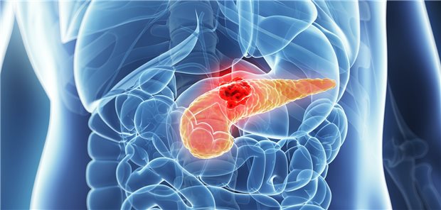 Pankreaskarzinom. Nach wie vor ist die frühe Diagnose eines solchen Malignoms eine Herausforderung.