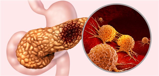 Pankreaskarzinom: Weniger als zehn Prozent der Erkrankten leben fünf Jahre nach der Diagnosestellung noch. Neue Therapieansätze werden dringend gesucht.