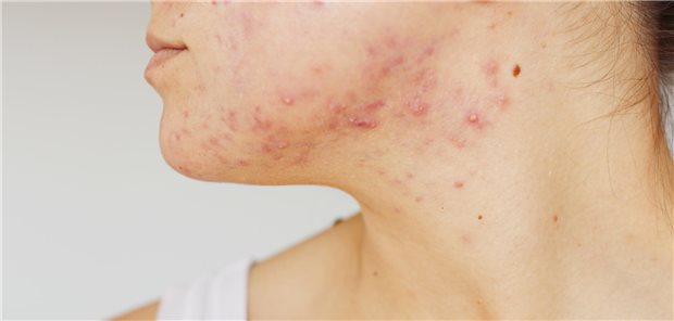 Akne am Kinn und dem Hals einer jungen Frau.