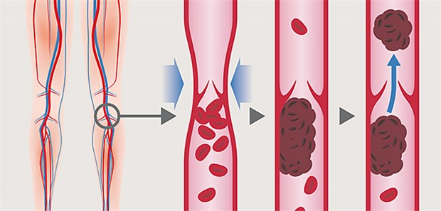 Venenthrombosen – DOAK auch im Alltag sicher Pathogenese der tiefen Venenthrombosen und Lungenembolie.