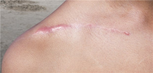 Mit Botulinumtoxin gegen Narben Pathologische Narbenbildung, also hypertrophe Narben und Keloide, ist für Dermatologen immer noch eine therapeutische Herausforderung.