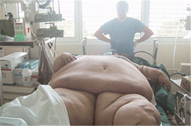 Letzte Hoffnung Magenoperation Patient mit 357 kg Gewicht: Bei extremer Adipositas ist die Magenverkleinerung eine wirksame Option.