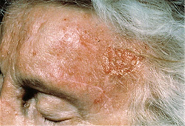 Bei wem sollte öfter nach Basaliomen geschaut werden? Patient mit Basaliom an der linken Schläfe. Bekannte Risikofaktoren für ein Basaliom sind blaue Augen und helle Haare.