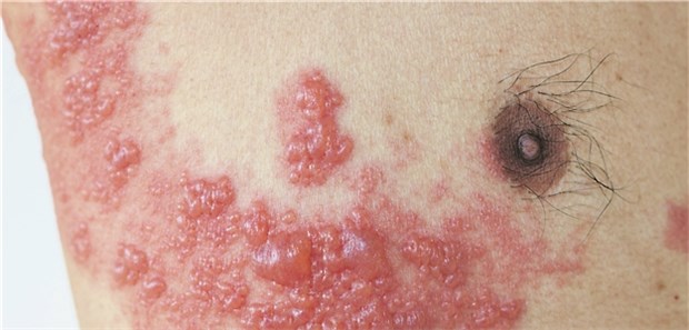 Bei Herpes zoster Schmerztherapie von Anfang an! Patient mit Herpes zoster im Brustbereich.