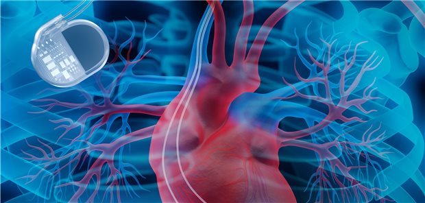 Patient mit Herzschrittmacher: In der neuen ESC-Leitlinie gibt es auch Empfehlungen zur Verringerung von Komplikationen der Schrittmachertherapie.