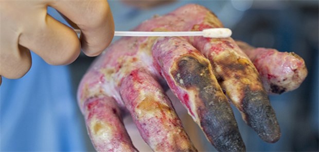 Mit Viren Antibiotika-resistente Bakterien bekämpfen Patient mit Verbrennung: Forscher versuchen mithilfe vonPhagen, bakterielle Infektionen zu verhindern.