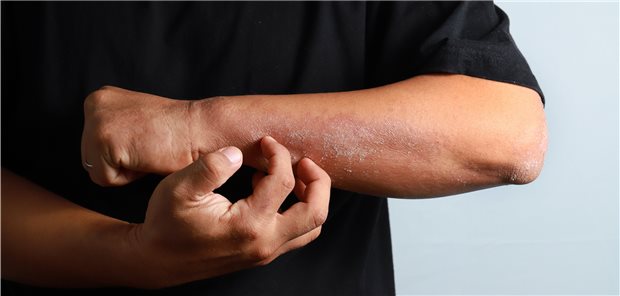 Upadacitinib ist ein neuer Wirkstoff zur Behandlung Erwachsener und Jugendlicher ab 12 Jahren mit mittelschwerer bis schwerer atopischer Dermatitis.