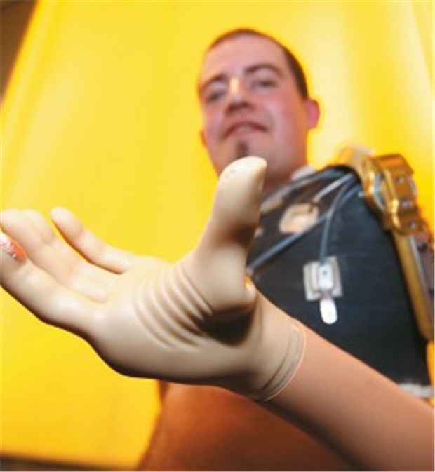 Trotz Armprothese - Patient fühlt Druck und Temperatur Patient mit gedankengesteuerter Armprothese: Am Zeigefinger befindet sich ein Fühler, mit dem Empfindungseindrücke zur Schulter übertragen werden. Durch einen chirurgischen Eingriff war die Sensorik der Hand auf die linke Schulter übertragen worden.