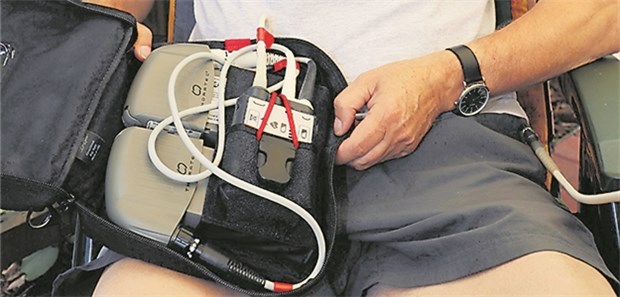 Patient mit zwei Unterstützungssystemen „HeartMate 3“. Kabel in die Brust verbinden die Turbinen am Herzen mit Akkus und Steuereinheiten.