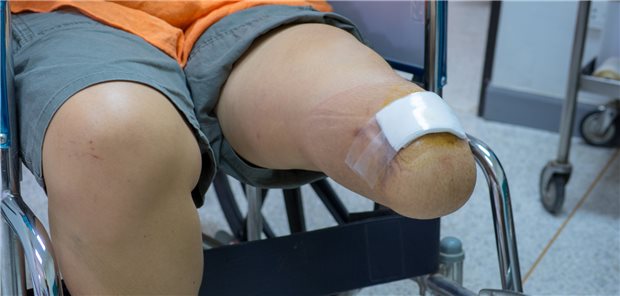 Patienten, denen mehrere Gliedmaßen amputiert worden, müssen künftig keine Genehmigung ihrer Krankenkasse einholen, wenn sie Heilmittel über einen längeren Zeitraum hinweg nutzen wollen.