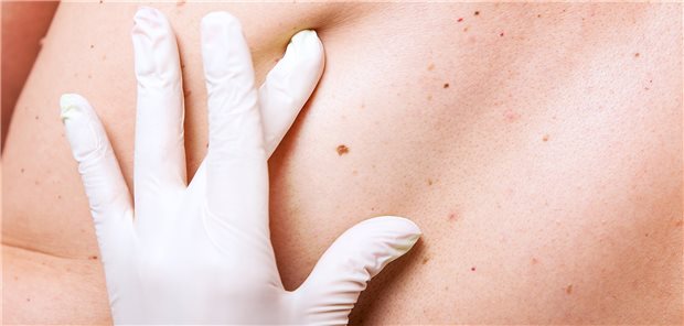 Arzt schaut sich Muttermal eines Patienten an. 