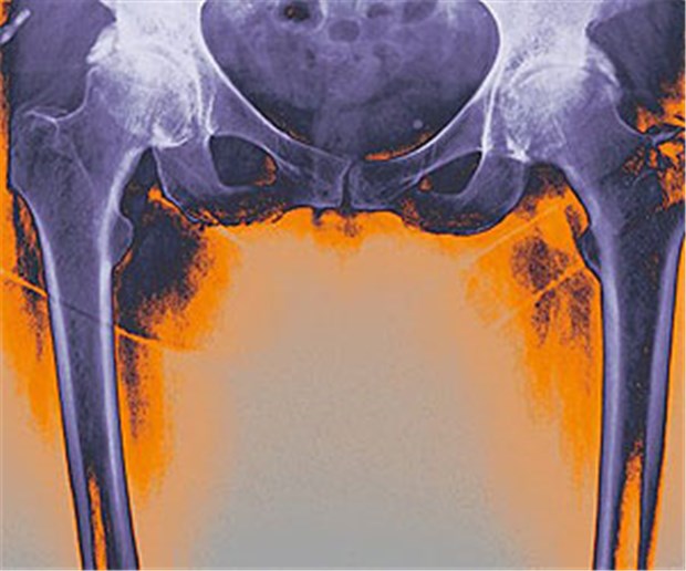 Für Männer gut, für Frauen weniger Patienten mit Coxarthrose brauchen oft eine Hüftprothese.