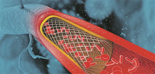 Patienten mit Stent erhielten in einer chinesischen Studie für ganze zwei Jahre nach Stent-Implantation eine duale Antiplättchen-Therapie (DAPT). 