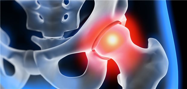 Patienten mit Typ-2-Diabetes haben ein erhöhtes Risiko für Hüftfrakturen; es steigt mit der Erkrankungsdauer.