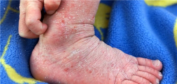 Patienten mit atopischer Dermatitis kann das ewige Jucken um den Schlaf bringen.