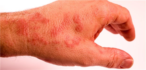 Patienten mit ausgeprägter atopischer Dermatitis hatten in der Studie ein doppelt so hohes Wirbelkörperfrakturrisiko.