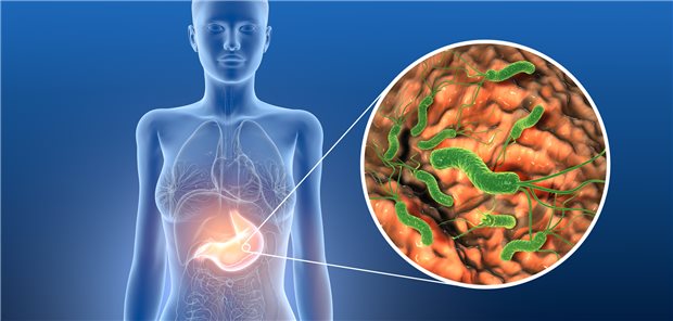 Patienten mit einer Helicobacter pylori-Infektion können Magenblutungen bekommen, wenn sie regelmäßig Aspirin einnehmen.
