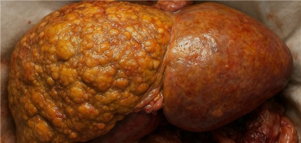 Patienten mit einer MASLD dürfen sich freuen: In der Pipeline befinden sich viele Wirkstoffe, die den Fibrosegrad verbessern sollen.