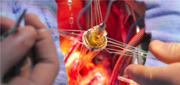 Patienten mit mechanischer Herzklappe sollte nach der US-Leitlinienempfehlung zur Reduktion der Rate an postoperativen Blutungen keine Acetylsaliclysäure (ASS) verschrieben werden. (Symbolbild)