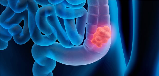 Patienten mit metastasiertem Kolorektalkarzinom können von einer Therapie mit Immuncheckpointinhibitoren profitieren, entweder als Mono- oder auch kombinierte Therapie.