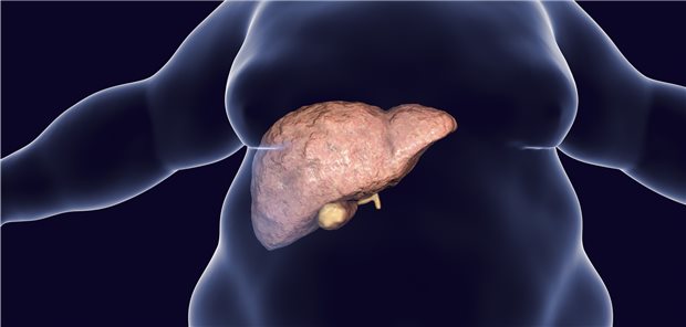 Patienten mit nichtalkoholischer Fettleber sind nicht nur häufig adipös. Viele von ihnen haben einer aktuellen Studie zufolge auch einen unkontrollierten Bluthochdruck.