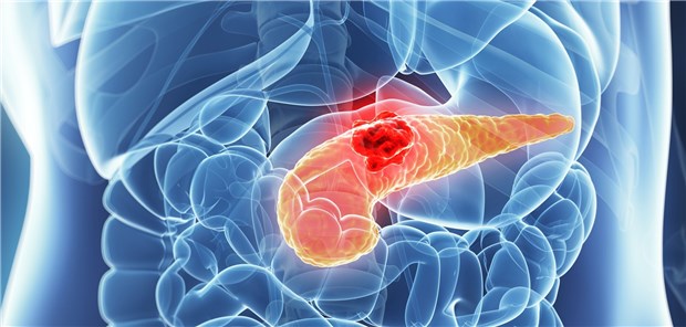 Patienten mit resezierbarem Pankreaskarzinom leben mit einem modifizierten FOLFIRINOX-Regime fast doppelt so lang progressionsfrei wie nach einer Behandlung mit Gemcitabin.