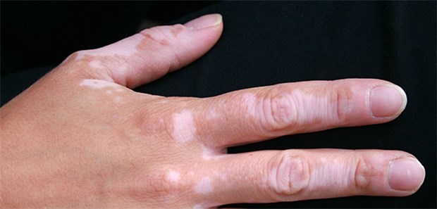 Zellen vom Po helfen Vitiligo-Patienten Patienten mit stabiler Vitiligo: Ärzte können Patienten mit Hauttransplantation vom eigenen Po helfen.