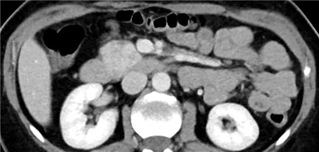 Patientenfall 1: CT-Abdomen mit Nachweis einer Raumforderung (4 × 3,2cm) im Pankreaskopf (Pfeil).
