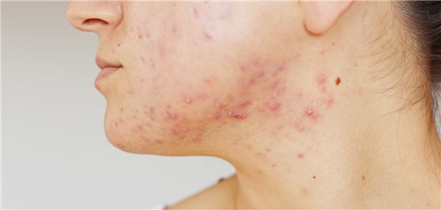 Patientin mit Akne: Schamgefühle bei gut sichtbaren Krankheiten wie Akne oder Psoriasis können so weit gehen, dass Betroffene sich nicht mal mehr im Spiegel anschauen oder die eigene Haut berühren wollen.&#xA;
