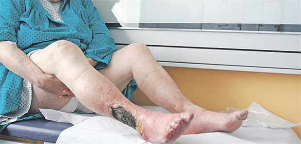 Patientin mit PAVK: Gestörte Wundheilung bei Unterschenkelthrombose.