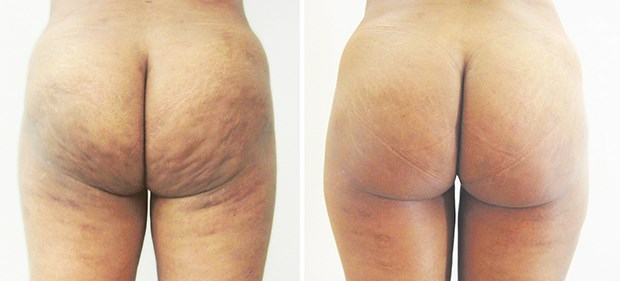 Cellulite: Viele Therapie-Optionen, aber wenig Evidenz Patientin mit Zellulitis der Glutealregion Grad 2 vor (links) und drei Tage nach Laserlipolyse.