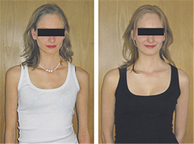 Keine Anorexie, sondern Histamin-Intoleranz Patientin mit einem BMI von 15,2 vor (links) und nach sechs Monaten histaminarmer Diät.
