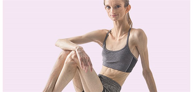 Patientin mit generalisierter Lipodystrophie.