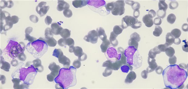 Blastenzellen bei akuter myeloischer Leukämie aus menschlichen Blutzellen (Krebs der weißen Blutkörperchen , Knochenmarkaspirat).