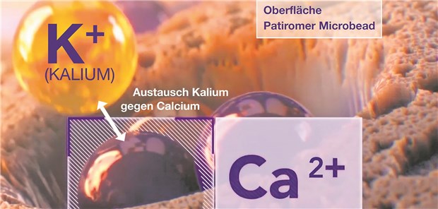 Patiromer tauscht im Darmlumen die überschüssigen Kaliumionen gegen Kalziumionen aus. Dadurch erhöht sich die Kaliumausscheidung mit den Fäzes und die Kaliumkonzentration im Serum sinkt. Vifor Fresenius Medical Care Renal Pharma